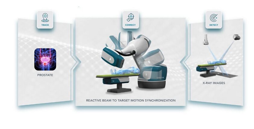 CyberKnife for Prostate Cancer
