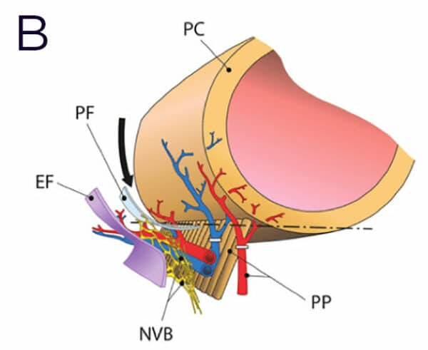 Nerve Sparing Prostatectomy